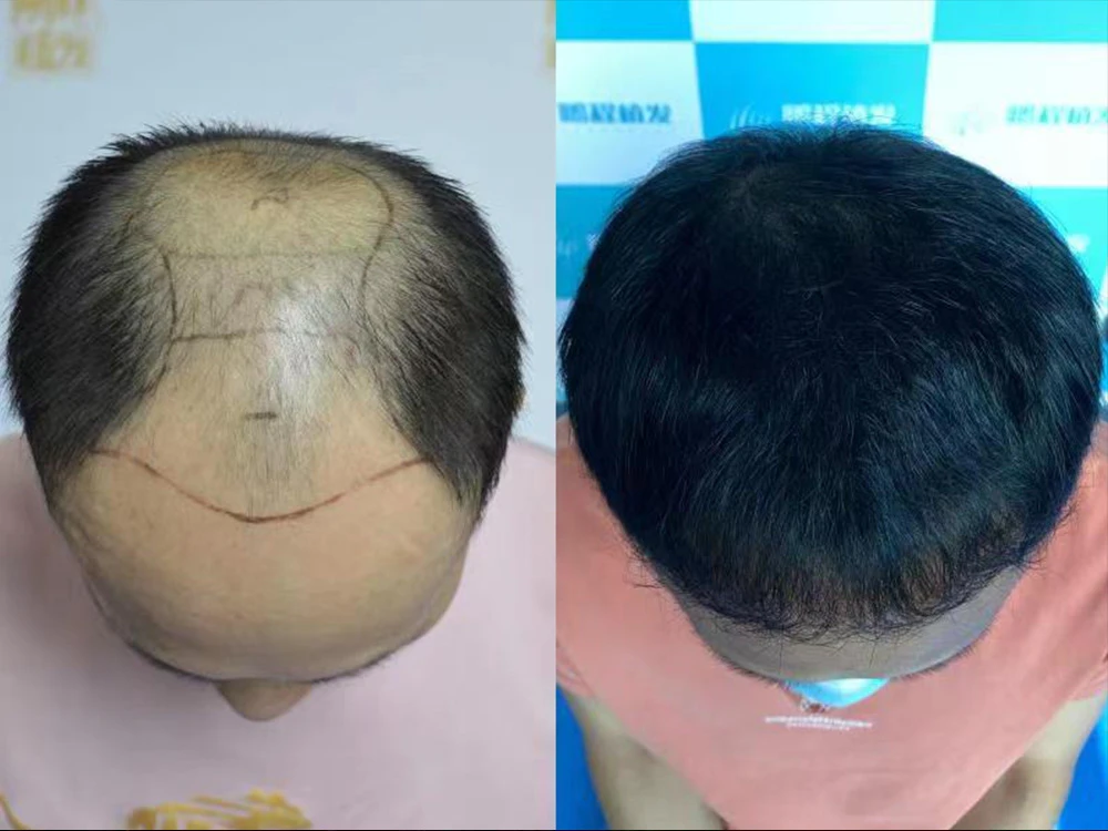 35 歲港男 M 字額北上深圳植髮，9 個月逆襲重生！從不敢露額到自信撩髮的秘密