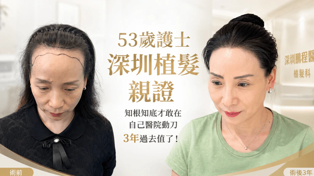 53歲護士深圳植髮親證：知根知底才敢在自己醫院動刀，3年過去值了！